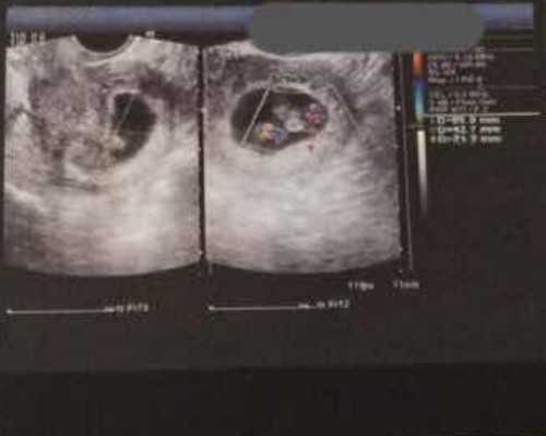 郑州代生正规公司 郑州大学第一附属医院供卵费用: ‘孕初期孕囊怎么看男女’